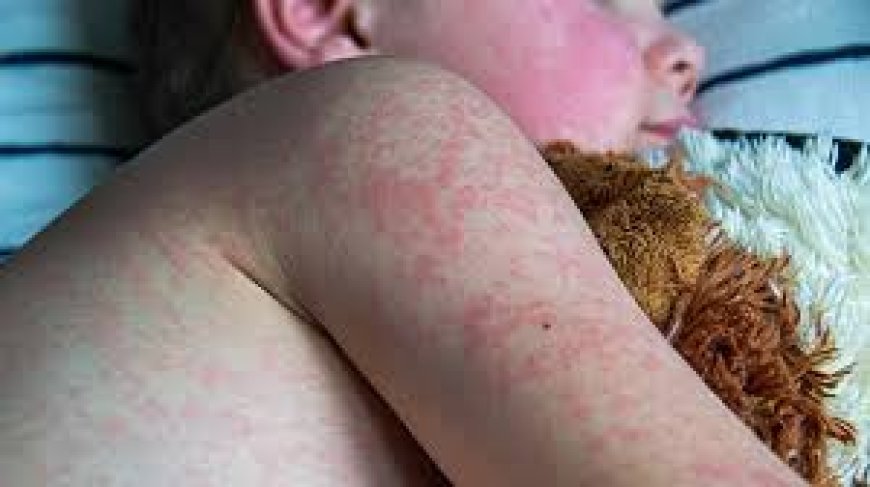 US hits 33-year high in measles cases as vaccination rates drop