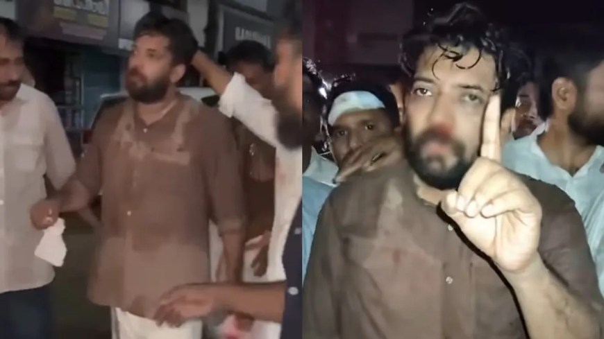 പോലീസ് അതിക്രമം: പരിക്കേറ്റ  ഷാഫിയുടെ മൂക്കിന്റെ 2 എല്ലുകൾക്ക് പൊട്ടൽ