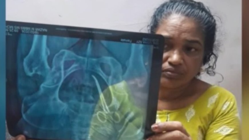 അഞ്ചു വര്‍ഷം മുന്‍പ് ശസ്ത്രക്രിയയ്ക്കിടെ വീട്ടമ്മയുടെ വയറ്റില്‍   കത്രിക  മറന്നുവെച്ചു; ആലപ്പുഴ  വണ്ടാനം മെഡിക്കൽ കോളജിനെതിരെ ഗുരുതര പരാതി