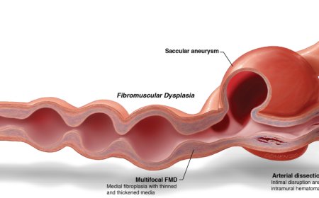More than 90% of patients are women: Is this why this cardiovascular disease is overlooked?