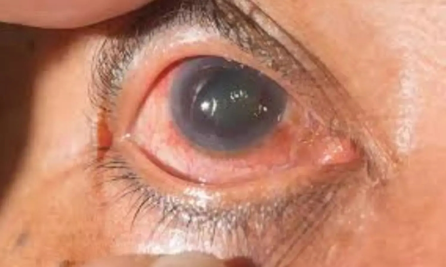 Conjunctivitis cases surge in Chennai; doctors urge hygiene and prompt care