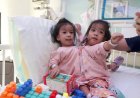 Conjoined twins separated following six-hour surgery in Saudi Arabia