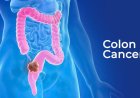 Doctors say this 'embarrassing' symptom could be a warning sign of colorectal cancer