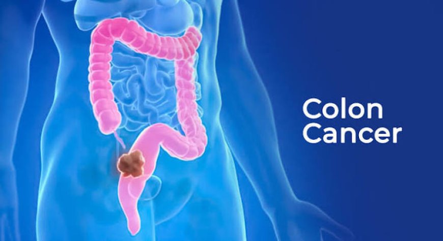 Doctors say this 'embarrassing' symptom could be a warning sign of colorectal cancer