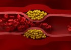 US cardiologists issue new guidelines for how to manage cholesterol