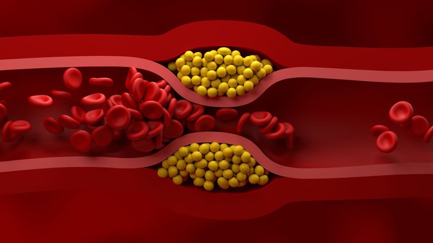 US cardiologists issue new guidelines for how to manage cholesterol